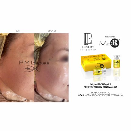 Biphasic Pre Peel Yellow Med Peel With Idebenone Renewal 365 / Желтый пилинг с идебиноном и маслом персиковой косточки, 7 мл*2(изображение 2)