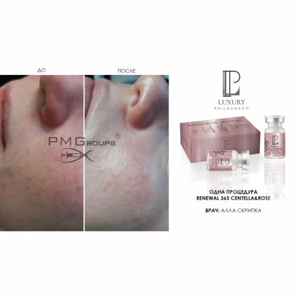 Biphasic Centella & Rose Med Peel Renewal 365 + Rose / Двухфазный пилинг для куперозной кожи с розой и центеллой азиатской, 7 мл*2(изображение 2)